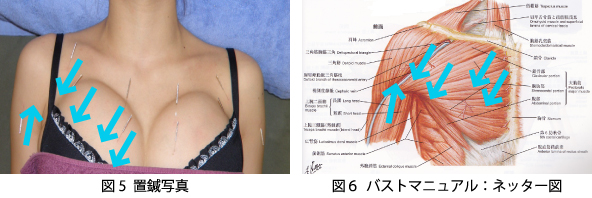 図5 置鍼写真,図6 バストマニュアル：ネッター図