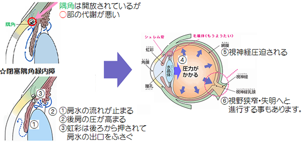 開放隅角緑内障