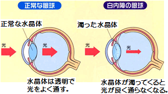 白内障