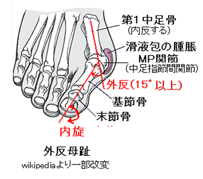 外反母趾